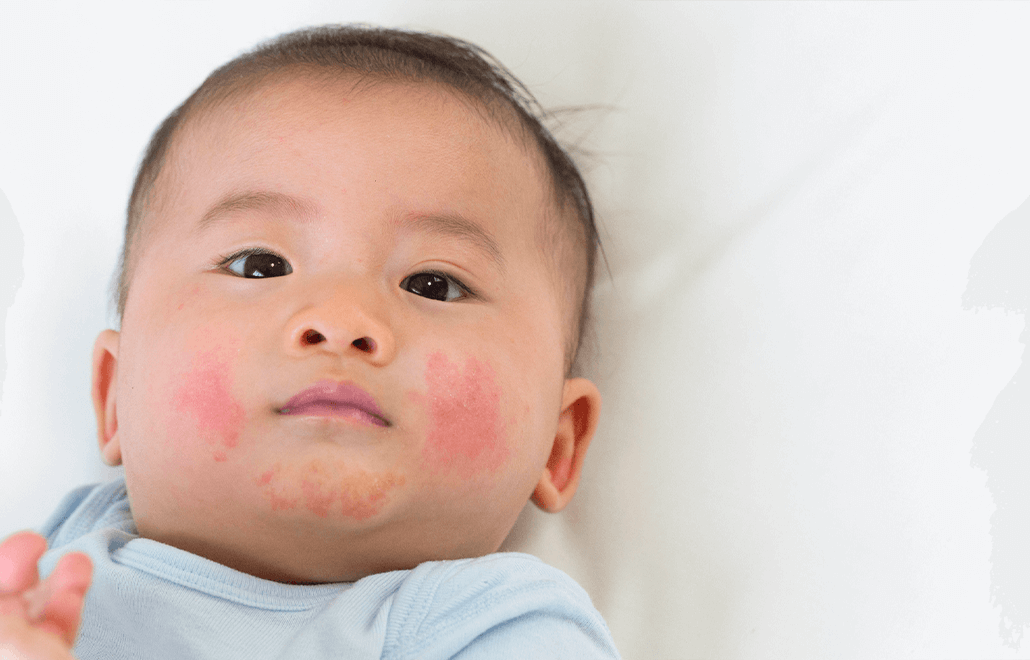 Allergies, Allergy Management Plan, child allergies, pediatrician